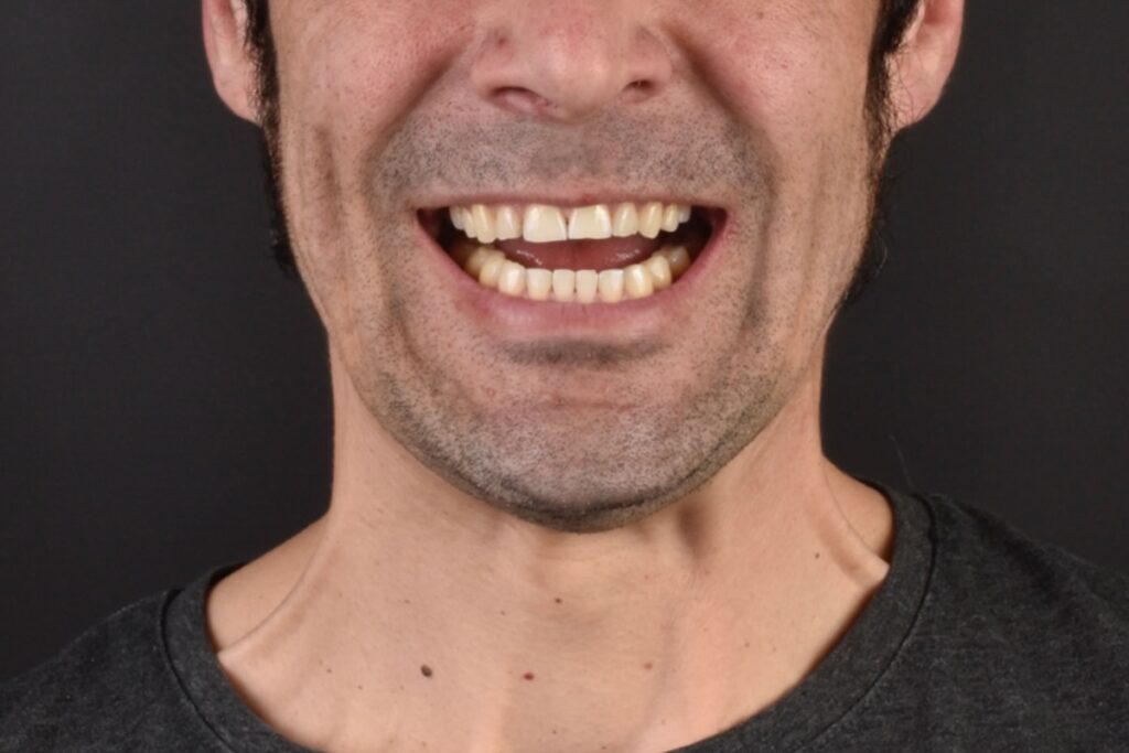 Antes de Carillas dentales en Oviedo - Clínica Dental Miguel González 1