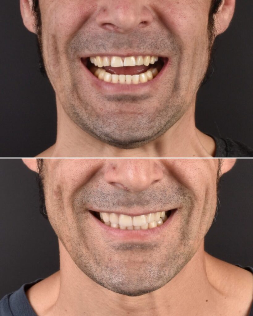 Carillas dentales en un paciente adulto: bordes desgastados recuperados con una línea regular.