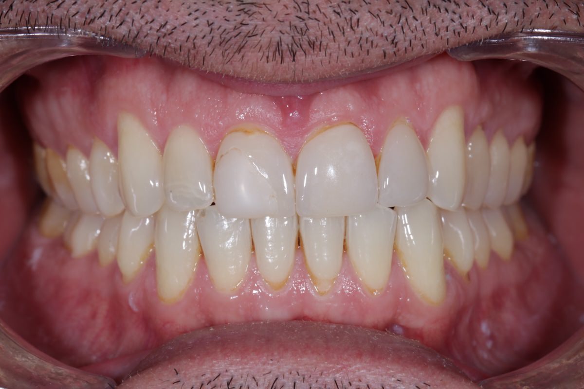 Dientes con tonos desiguales, manchas junto a la encía y bordes gastados antes de colocar carillas.