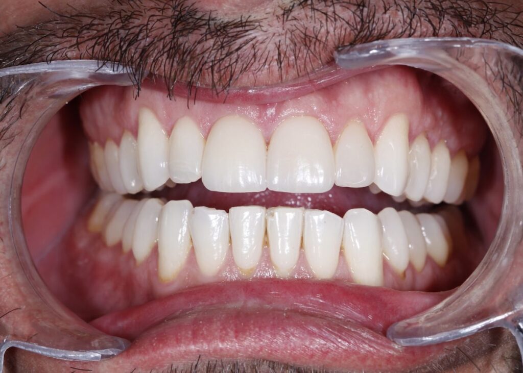 Resultado con carillas dentales en Oviedo: color uniforme entre las piezas y bordes con línea regular.