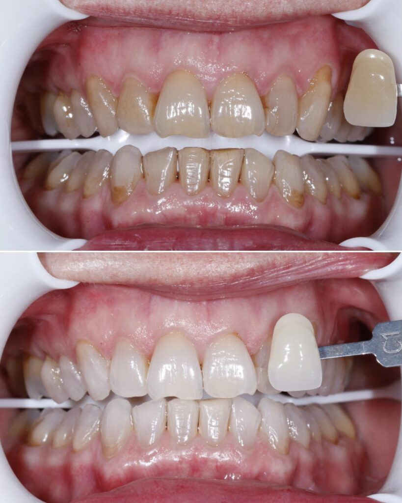 Antes después Blanqueamiento dental en Oviedo con un plan a tu medida - Centro Odontológico Miguel González 3