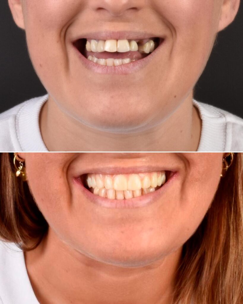 Antes-y-despues-rehabilitacion-Oral-Completa-en-Oviedo-con-un-plan-a-tu-medida-Centro-Odontologico-Miguel-Gonzalez-3